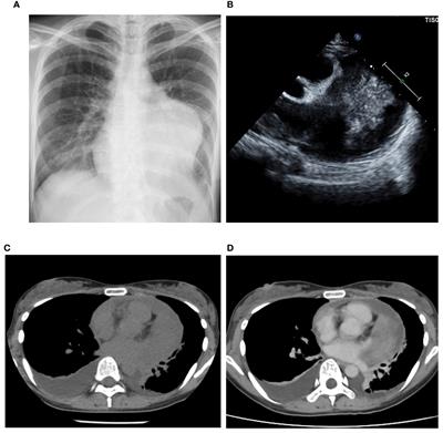 Case report: Characteristics and nature of primary cardiac synovial sarcoma